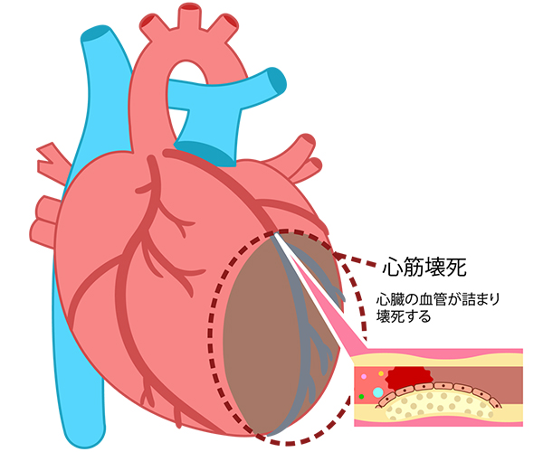 心筋梗塞
